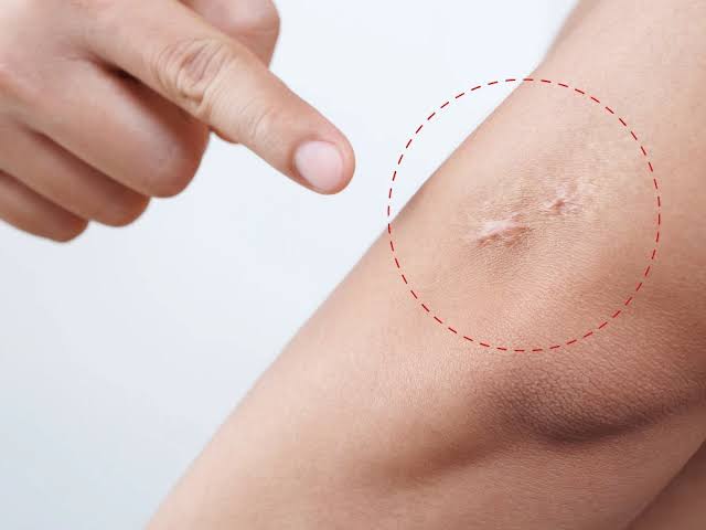 Scar Removal