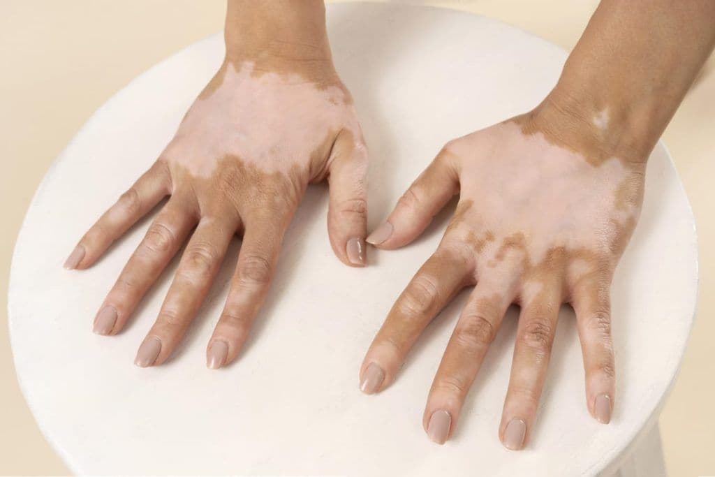 Vitiligo Surgery