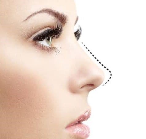 Rhinoplasty (Nose Job)