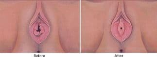 Hymenoplasty