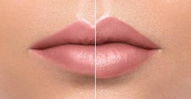 Lip Enhancement / Reduction