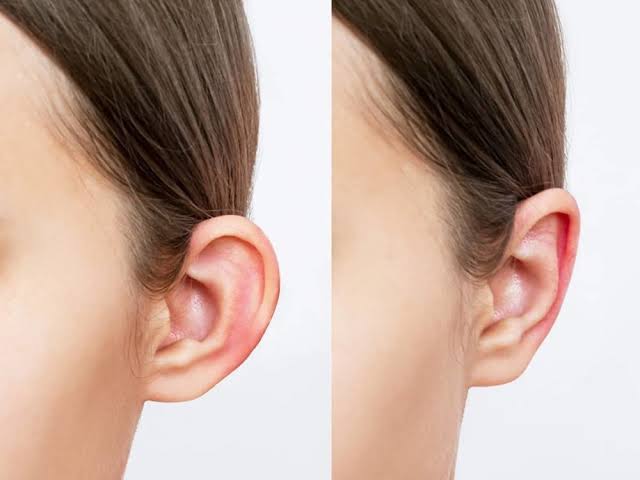 Ear Reshaping
